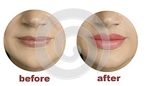Girl lips before and after augmentation shape
