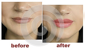 Girl lips before and after augmentation shape beautiful