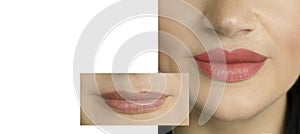 Girl lips before and after perfect augmentation shape beautiful