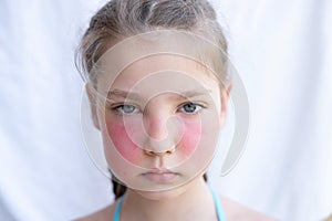 A girl with a painful hot sunburn, a problem of redness of the skin of the face, swelling. allergic reaction. Sun damage