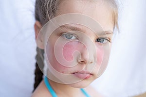 A girl with a painful hot sunburn, a problem of redness of the skin of the face, swelling. allergic reaction. Sun damage