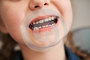 Girl with plates being examined by dentist at clinic