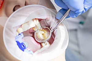 Girl at the reception at the dentist. treatment of carious tooth. on top of your teeth caries