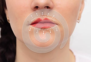 Girl`s face with painted lips and white markers on the lips. The concept of lip augmentation using contouring and