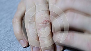 Girl`s hand with eczema and psoriasis strong itching