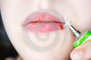 Girl's lips affected by herpes.