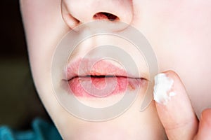 Girl\'s lips affected by herpes.