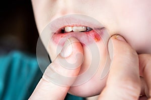 Girl's lips affected by herpes.