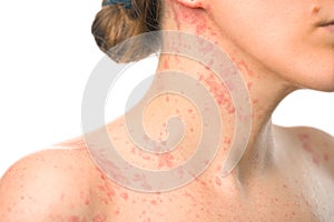 A girl`s neck covered with an allergic rash close-up on a white background