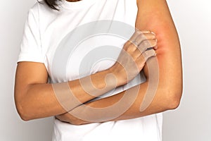 Girl scratching itch on hand, suffer from dry skin or pruritus, animal allergy, insect bites. Studio