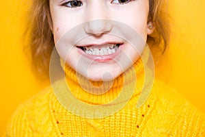 Girl shows her teeth-pathological bite, malocclusion, overbite. Pediatric dentistry and periodontics, bite correction. Health and