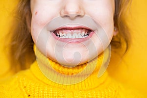 Girl shows her teeth-pathological bite, malocclusion, overbite. Pediatric dentistry and periodontics, bite correction. Health and