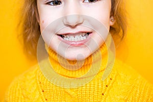Girl shows her teeth-pathological bite, malocclusion, overbite. Pediatric dentistry and periodontics, bite correction. Health and photo