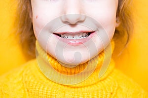 Girl shows her teeth-pathological bite, malocclusion, overbite. Pediatric dentistry and periodontics, bite correction. Health and photo