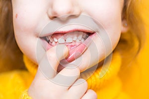 Girl shows her teeth-pathological bite, malocclusion, overbite. Pediatric dentistry and periodontics, bite correction. Health and photo