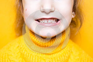 Girl shows her teeth-pathological bite, malocclusion, overbite. Pediatric dentistry and periodontics, bite correction. Health and photo