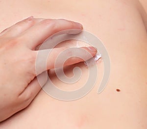 A girl smears a scar on her body with a healing cream to heal scars and scars, close-up, copy space