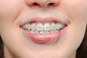 Girl smiles with braces photo