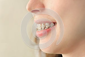 Girl smiles with braces