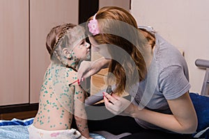 Girl suffering from chickenpox sores mom misses zelenkoj photo