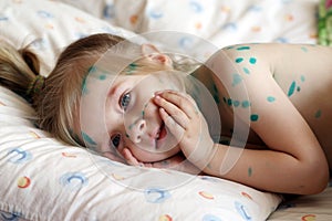 Girl suffers chickenpox