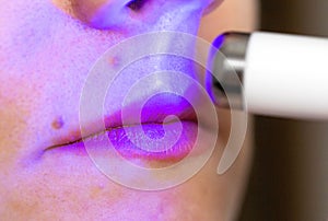 Girl treats inflamed red acne on the skin of the face with a laser cosmetic pen, cosmetic procedure. Macro