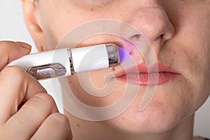 Girl treats inflamed red acne on the skin of the face with a laser cosmetic pen, cosmetic procedure. Macro