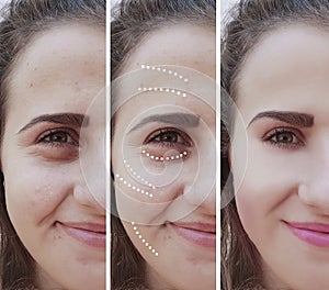 Girl wrinkles eyes before and after bloating therapy effect treatment procedures