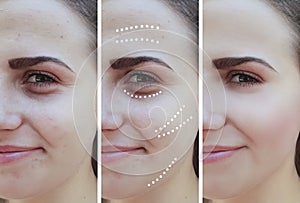 Girl wrinkles eyes before and after  effect procedures