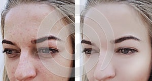 Girl wrinkles eyes before and after removal , bags, bloating