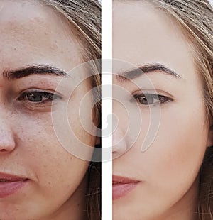 Girl wrinkles eyes before and after removal procedures, bags, bloating