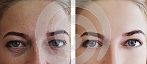 Girl wrinkles eyes before and after treatments removal