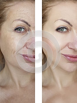 Girl wrinkles before and after lifting therapy treatments