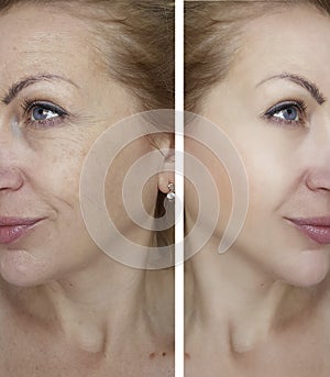 Girl wrinkles before and after removal crease