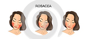 The girls face, rosacea