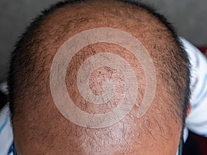 Glabrous on Male Bald head .