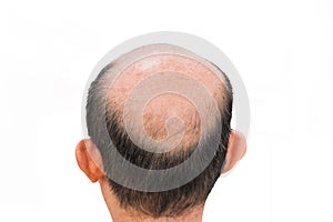 Glabrous on Male Bald head isolated on white background