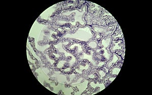 Glandular epithelium. Green gland cancer preparation.