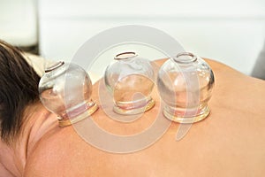 Glass cups sucked on back of young woman - closeup detail of cupping therapy, alternative medicine form photo