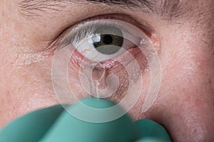 Glass eye prosthetic extraction of Ocular prosthesis
