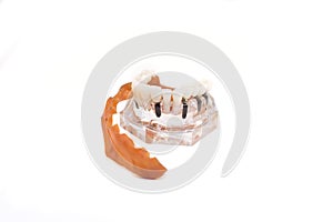 Glass jaw model with implanted
