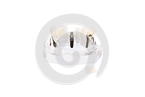 Glass jaw model with implanted dentures