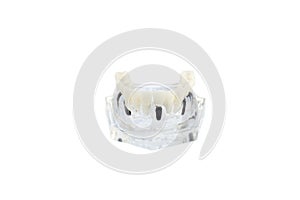 Glass jaw model with implanted dentures