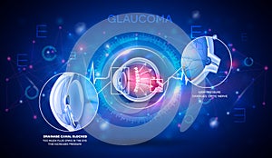 Glaucoma