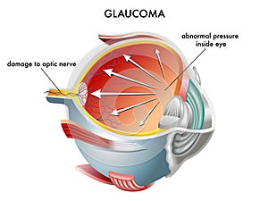 Glaukom 