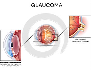 Glaucoma