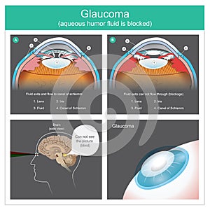 Glaucoma. Aqueous humour fluid exits and flow to canal of schlemm human eyes. Illustration.