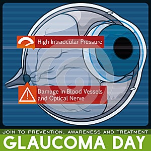 Glaucoma Day Design: Sick Eye Scan Due to this Disease, Vector Illustration