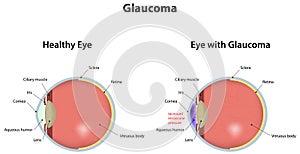 Glaucoma photo