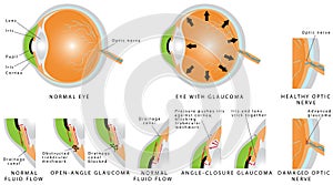 Glaucoma photo